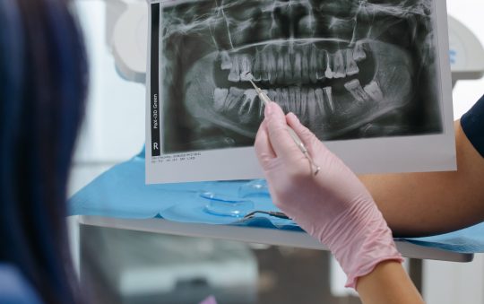 Five Advantages of Invisalign Over the Traditional Metal Braces